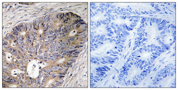 Immunohistochemistry analysis of paraffin-embedded human colon carcinoma tissue, using CAD Antibody. The picture on the right is blocked with the synthesized peptide.